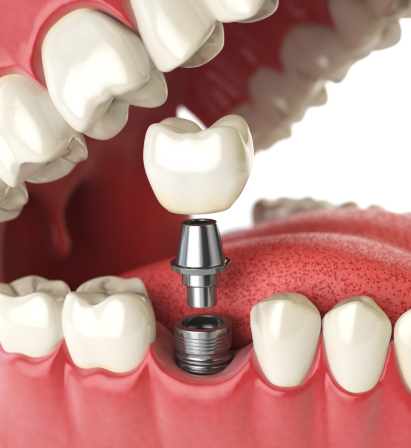 Dental Implant