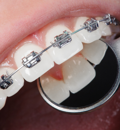 Teeth Treatment